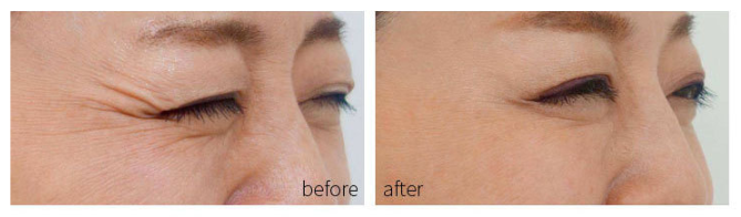 Acne Treatment Facial Mask Device